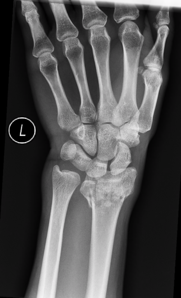 Wrist Fracture - Orthohub