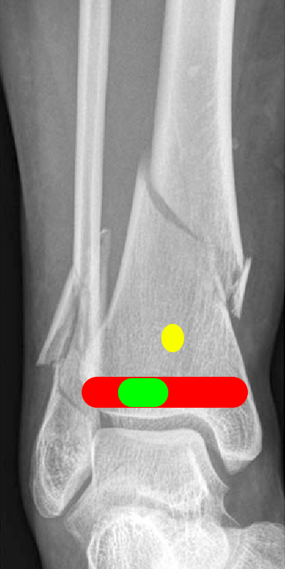 distal tibia fracture