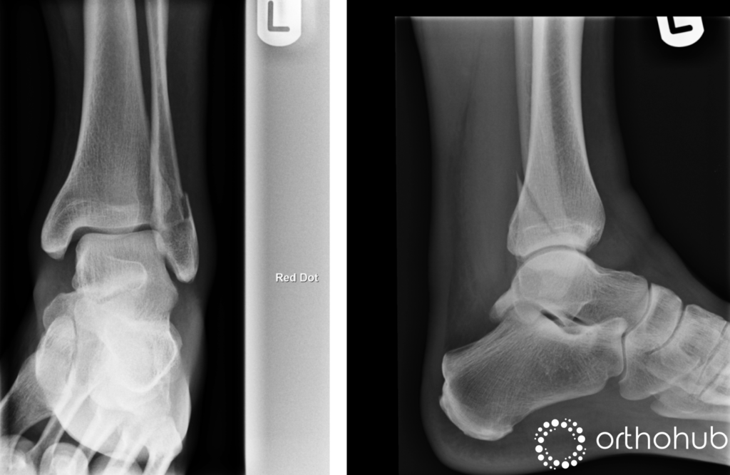 Weber B fracture · Virtual Fracture Clinic