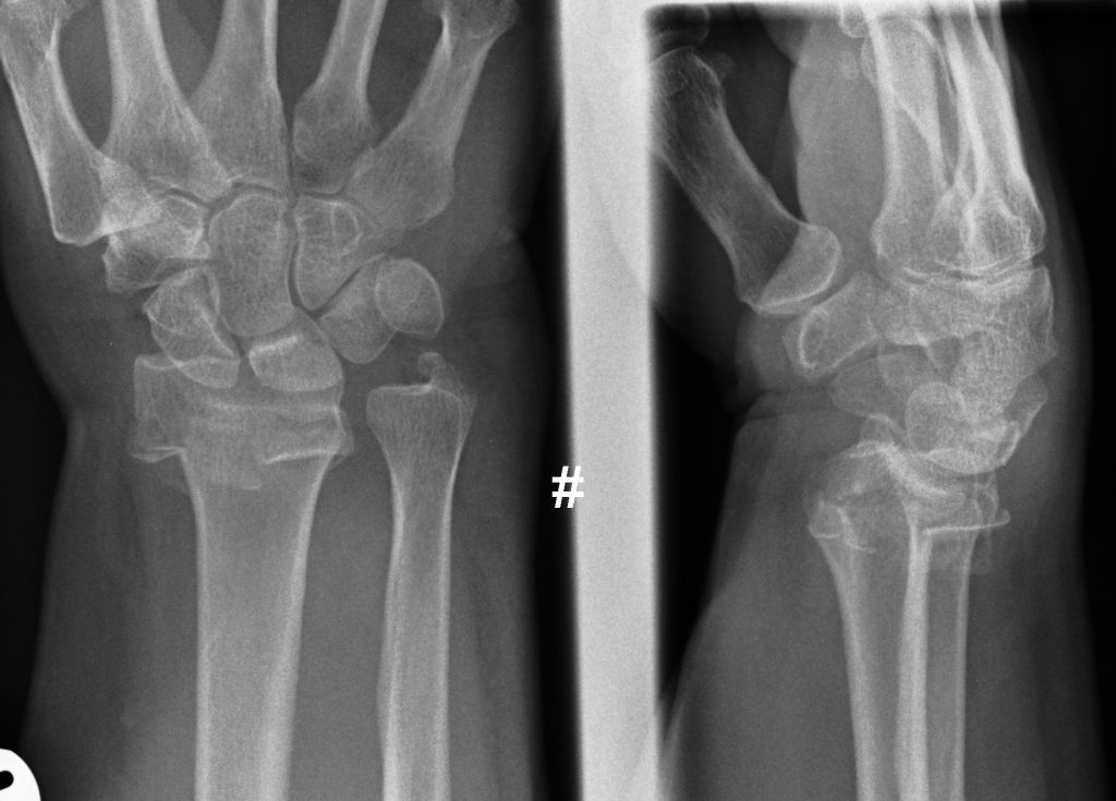 distal radius fracture cases - Orthohub